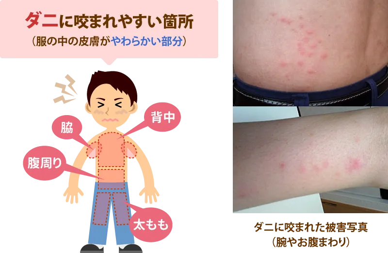 ダニに咬まれやすい箇所(腕やお腹まわり)