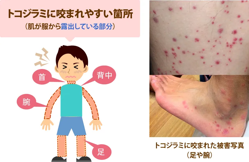 トコジラミに咬まれやすい箇所(肌が服から露出してる部分)