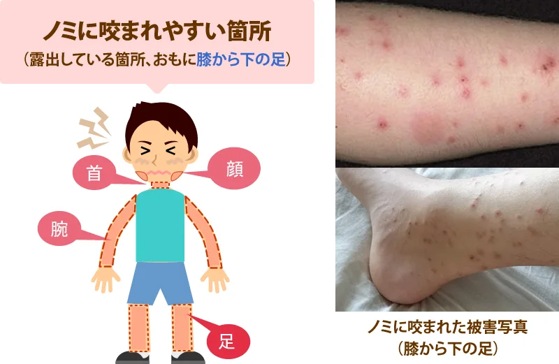 ノミに咬まれやすい箇所(肌が服から露出してる部分)